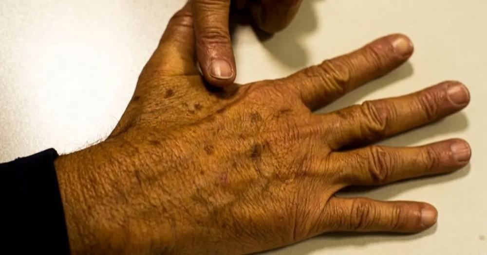 Dezembro laranja alerta para maior risco de câncer de pele no verão; entenda