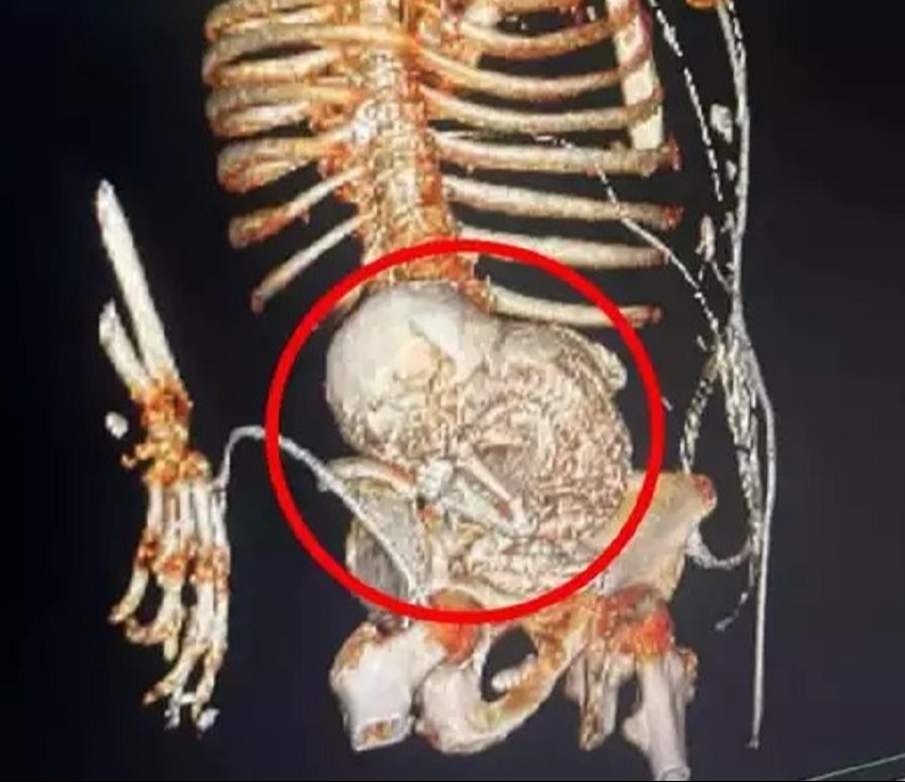 Mulher descobre feto mumificado na barriga: ‘Grávida há 56 anos’