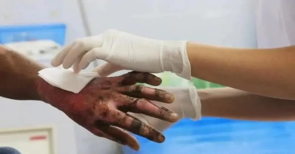 Internações por queimaduras de fogos de artifício cresce na Bahia entre 2021 e 2023; estado é o 3º com mais casos em jovens