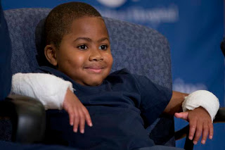 Primeiro menino a receber transplante duplo de mãos supera rejeições