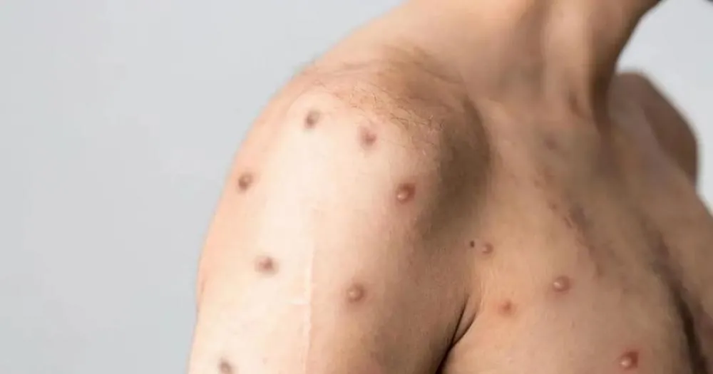 OMS declara que Mpox voltou a ser emergência sanitária global