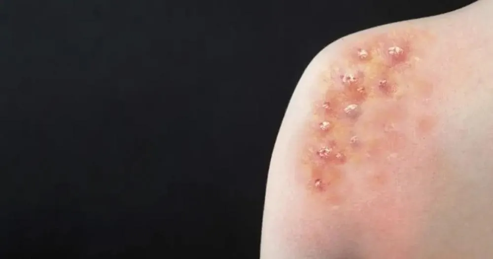 Bahia registra 38 casos de mpox em 2024; cerca de 21 dos pacientes infectados moram em Salvador