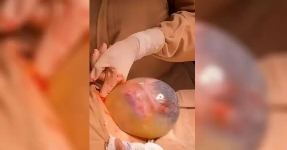Mãe dá à luz bebê em parto considerado raro; fato ocorreu no Centro Norte baiano