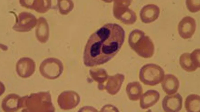 Novo medicamento para pacientes com anemia por deficiência de ferro passa a ser ofertado pelo SUS