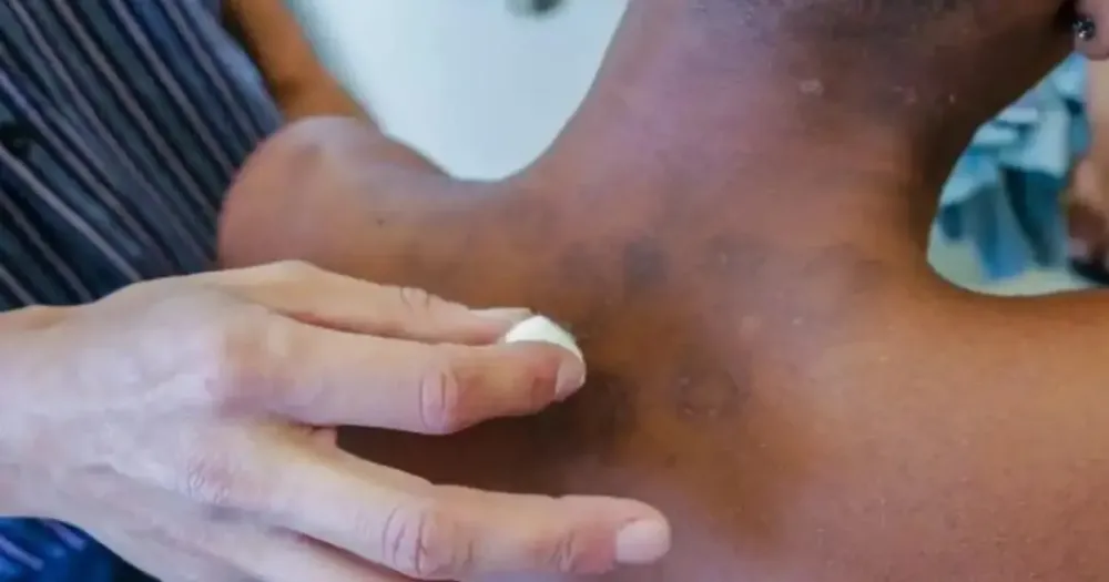 Anvisa autoriza testes para avaliar vacina inédita contra hanseníase no Brasil