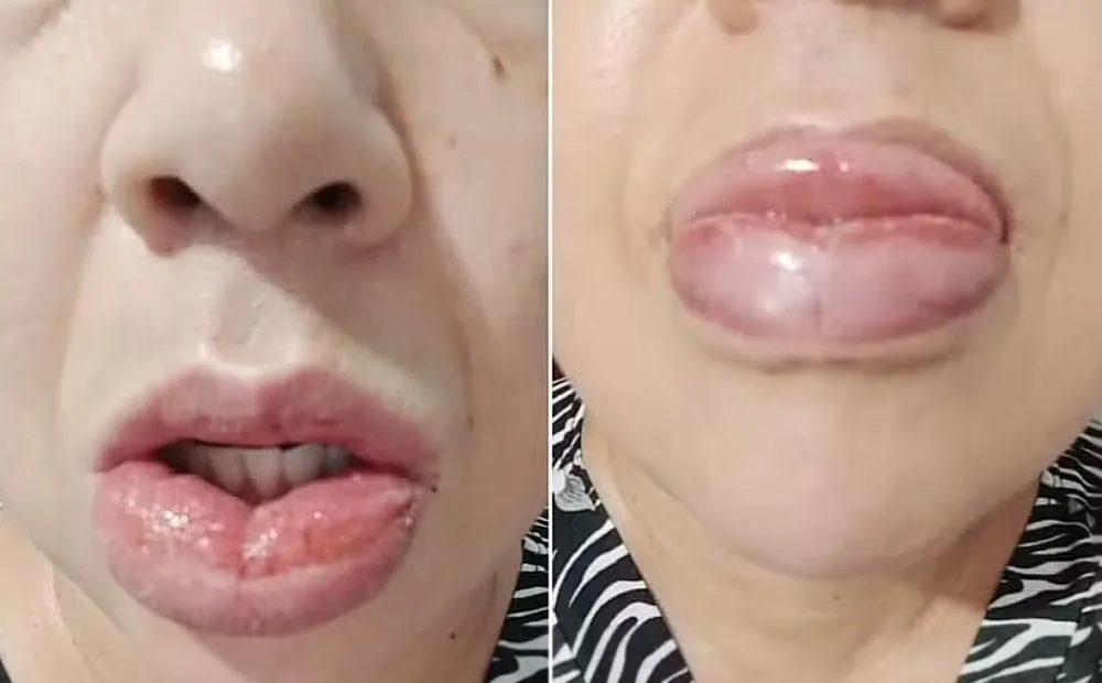 Educadora fica com a boca gigante após usar creme dental da Colgate