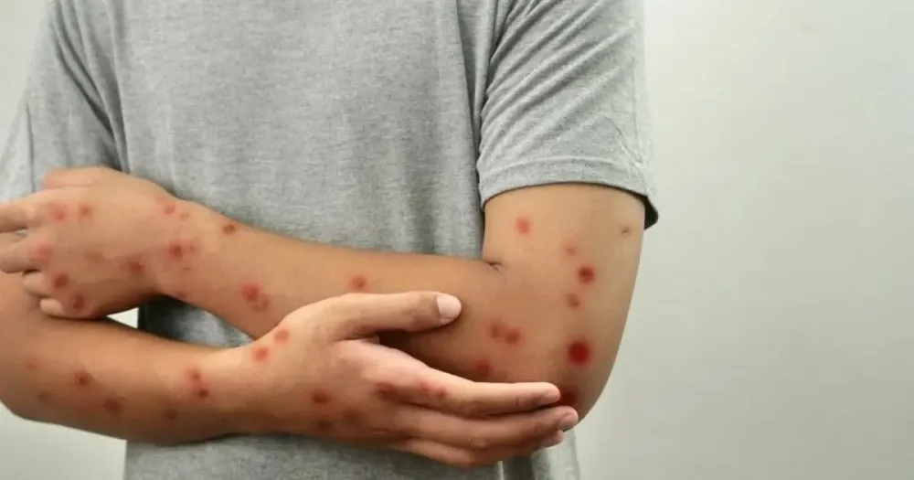 Anvisa determina ações de orientação sobre mpox e sarampo em portos, aeroportos e voos