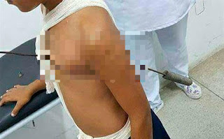 Garoto sobrevive após espeto atravessar o coração