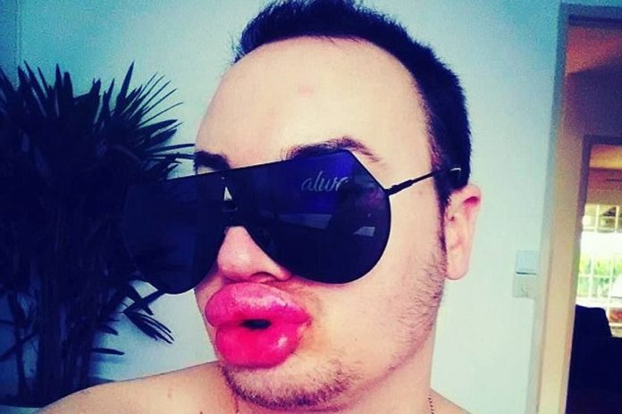 Jovem gasta R$ 48 mil para ter lábios iguais ao da atriz Marilyn Monroe