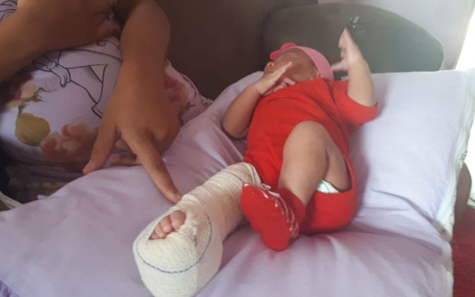Bebê tem fratura no fêmur após cesárea em hospital na Bahia; diretor médico alega parto difícil