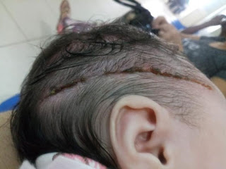 Recém-nascida leva 25 pontos na cabeça após ser cortada com bisturi durante parto