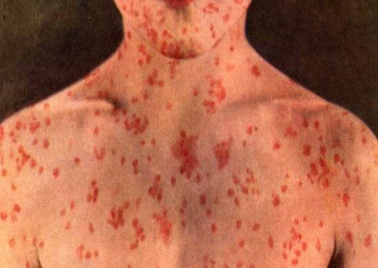 SARAMPO: SAIBA O QUE É, PREVENÇÃO, SINTOMAS E TRATAMENTO