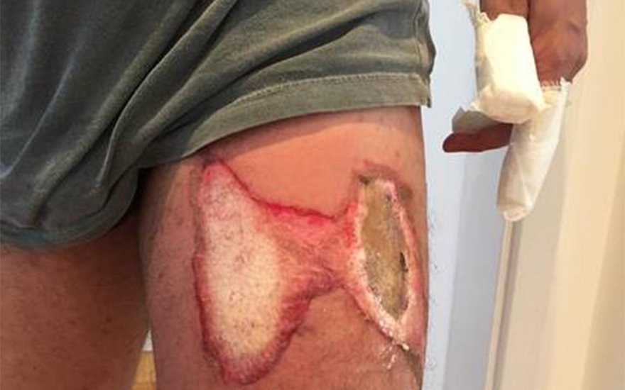 CELULAR EXPLODE NO BOLSO DA CALÇA E HOMEM SOFRE QUEIMADURAS DE 2º GRAU NA PERNA E NAS MÃOS