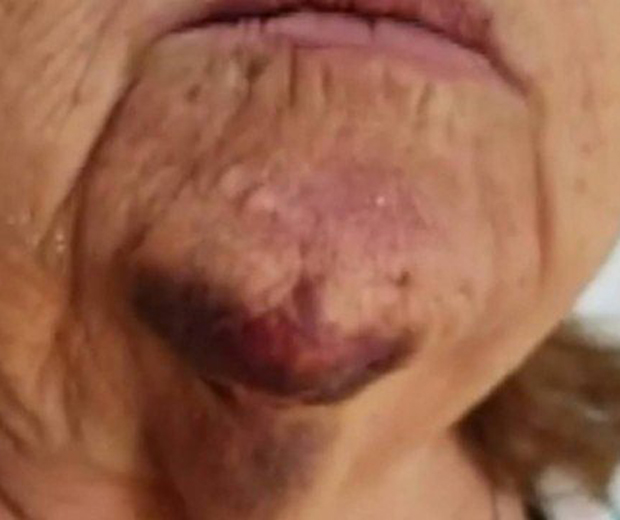 FILHO ATEIA FOGO NA MÃE IDOSA E ALEGA QUE ESTAVA INCOMODADO COM RONCO DELA