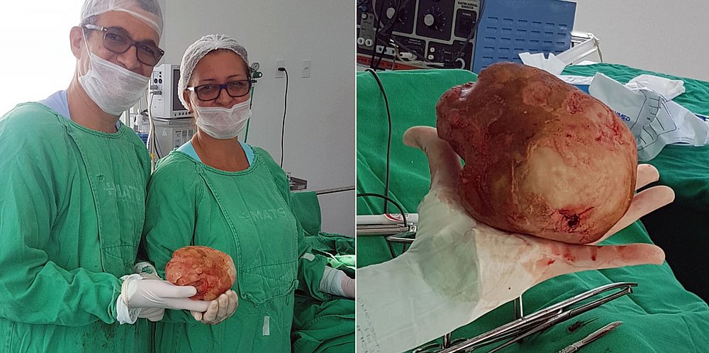 Baiano descobre em cirurgia que tinha pedra de quase 1,5 kg na bexiga