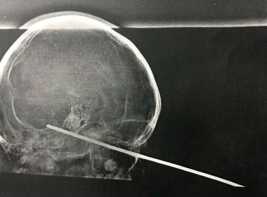 Santa Rita: Mãe de garoto que teve espeto cravado em olho aguarda por consulta