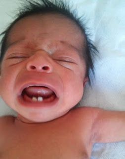Em caso raro, bebê nasce com dois dentes