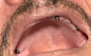 VÍTIMA DE FALSO DENTISTA INVESTIGADO NA BAHIA TEVE NOVE DENTES EXTRAÍDOS DE UMA VEZ APÓS SE QUEIXAR DE DOR EM UM DELES