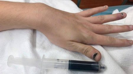 Mulher fica com sangue azul após tomar remédio para dor de dente