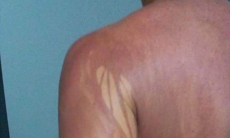 Mineiro fica com manchas no corpo depois de banho em praia na Bahia 