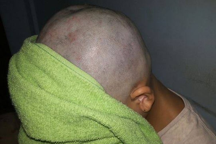 Pai raspa o cabelo da filha após ela fazer bullying com menina com câncer