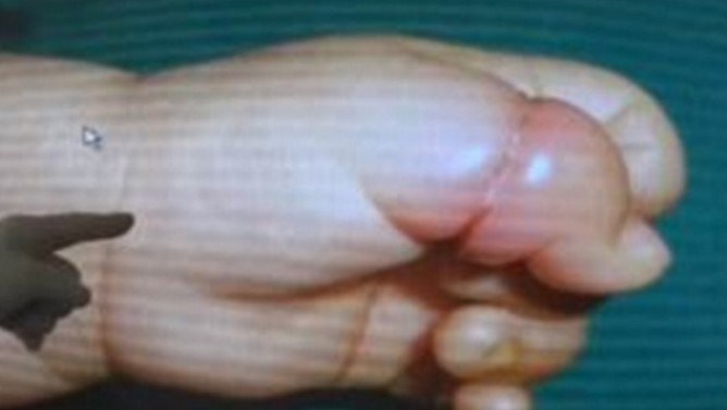 Bebê quase tem o dedo da mão amputado por causa de um fio de cabelo
