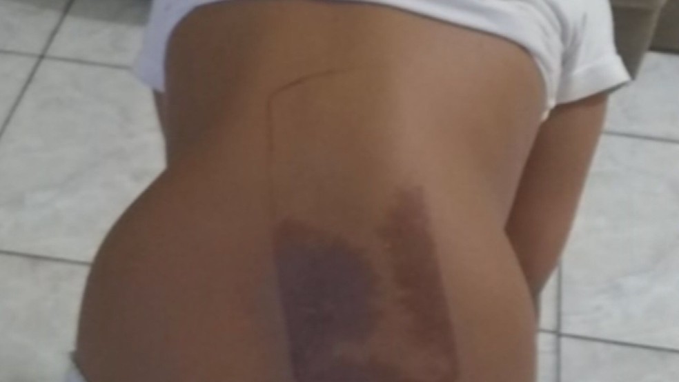 Criança de 7 anos sofre queimaduras nas costas após dormir em cima do celular