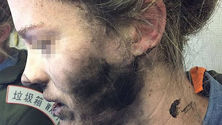Mulher sofre queimaduras no rosto após explosão de fones de ouvido durante voo