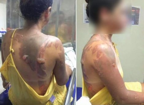 Adolescente é queimada com ácido pela “amiga” na Bahia por causa de homem