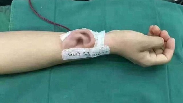 Revolução: Médicos implantam orelha ‘cultivada’ por meses em braço de paciente