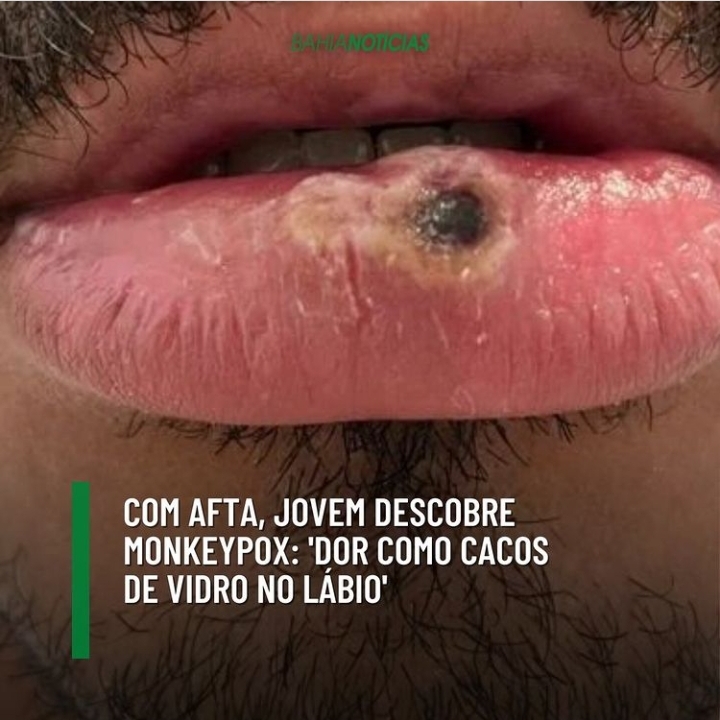 COM AFTA, JOVEM DESCOBRE MONKEYPOX: 'DOR COMO CACOS DE VIDRO NO LÁBIO'