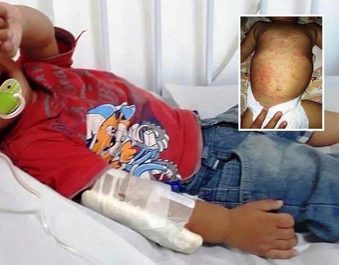 Criança está internada após comer ovo estragado e com larva distribuído por prefeitura