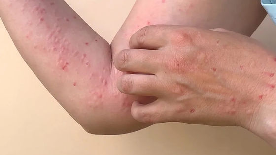 Bahia já soma 55 casos de Monkeypox